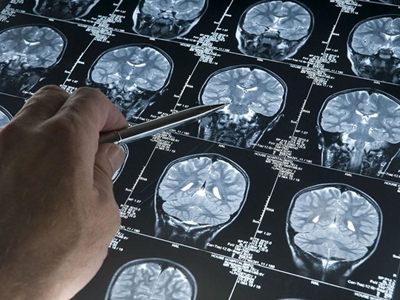 Pfizer pulls out of research into Alzheimer's