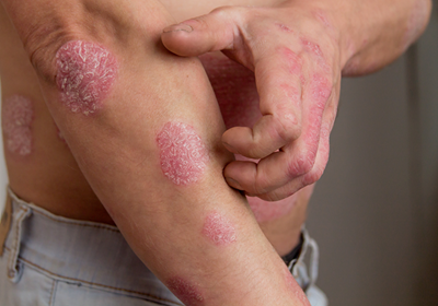 World Psoriasis Day 2023: 1 million South Africans suffer