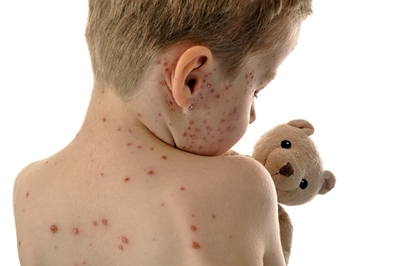 Measles outbreak cases increase to 35 in Limpopo
