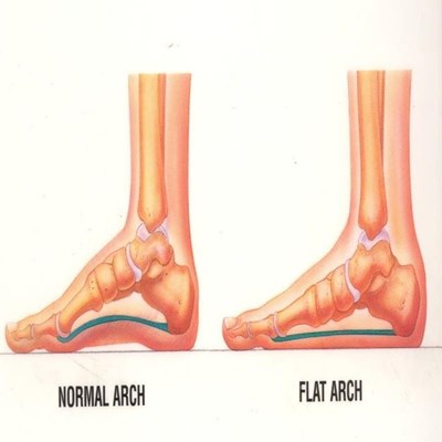 Flatfoot and its effect on your body | Graaff-Reinet Advertiser