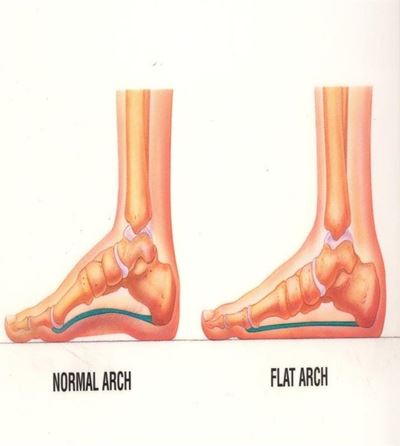 Flatfoot and its effect on your body