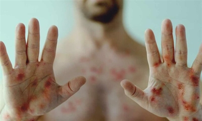 Mpox- Here are symptoms you should look out for