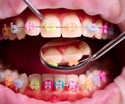 Support needed for Envir’s orthodontic treatment 