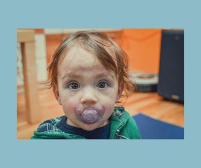 Vaccination remains best defence against measles