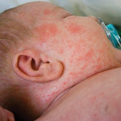 Department urges parents to vaccinate as rubella cases rise