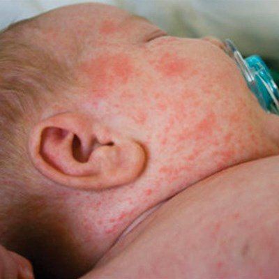 Department urges parents to vaccinate as rubella cases rise