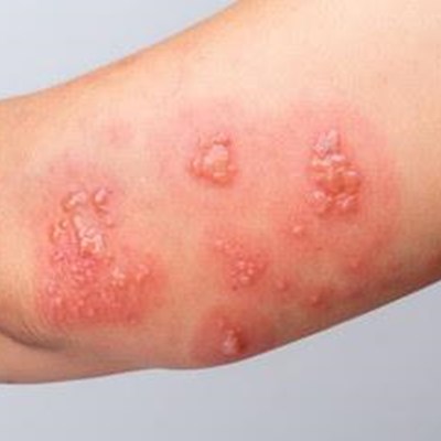 Scabies Rch Scabies rears its itchy head in George | George Herald