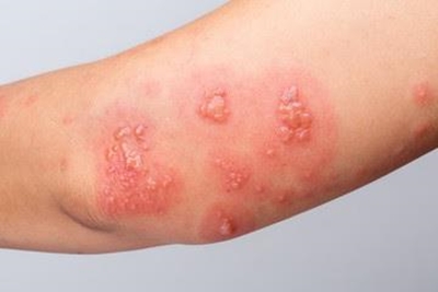 Scabies rears its itchy head in George