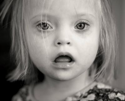 Five things to know about Down syndrome