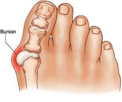 Foot ailments: Bunions
