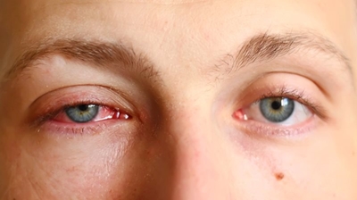 Conjunctivitis: What you should know