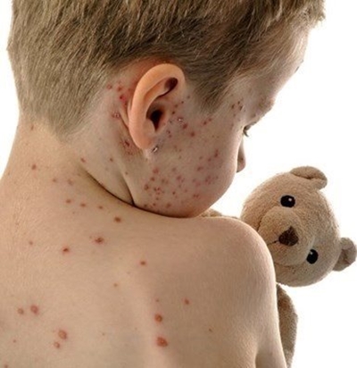 'Pocket outbreak' of Rubella in George