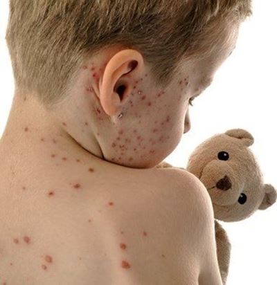 'Pocket outbreak' of Rubella in George
