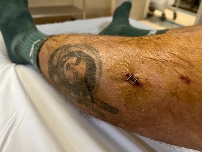 Surfer recounts seal attack