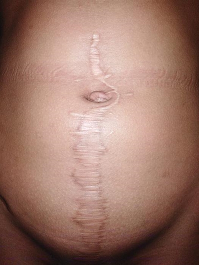 Long wait for surgery scars girl for life