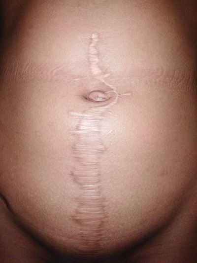 Long wait for surgery scars girl for life