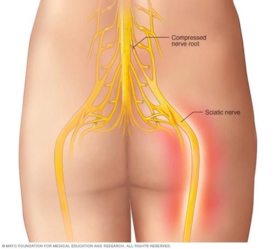 Sciatica - a pain in the leg