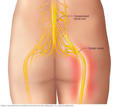 Sciatica - a pain in the leg