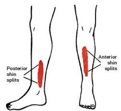 How to identify shin splints