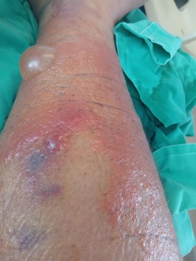 Spinnekoppie hospitaliseer boer vir 25 dae