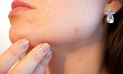 Tips to help control teenage acne