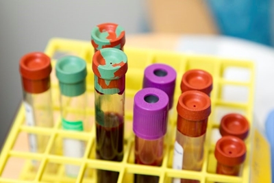 SA records fourth Monkeypox case