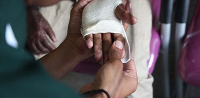 Child Safety Month: Children need your help to prevent burn injuries