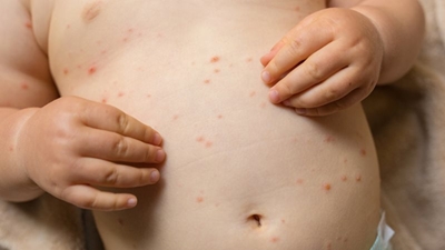 US county declares state of emergency amid measles outbreak