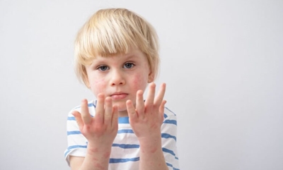 The link between eczema and mental health