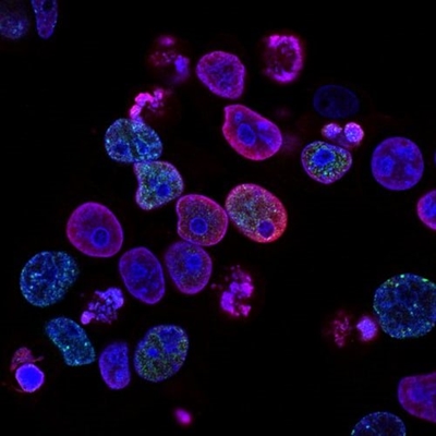 Covid-19: what cancer patients need to know