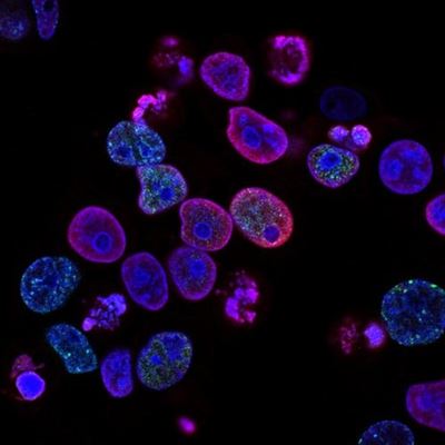 Covid-19: what cancer patients need to know