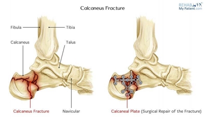 Understanding ankle fractures