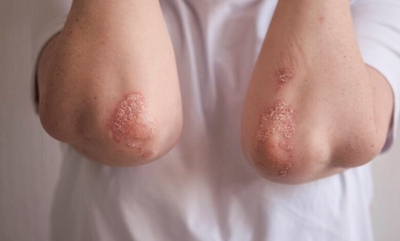 All about psoriasis in children
