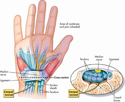 Carpal Tunnel Syndrome