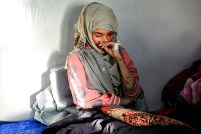 Disfigured by acid, the face of violence against Yemen's women