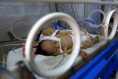 Yemeni conjoined twins die in blockaded Sanaa: Rebels