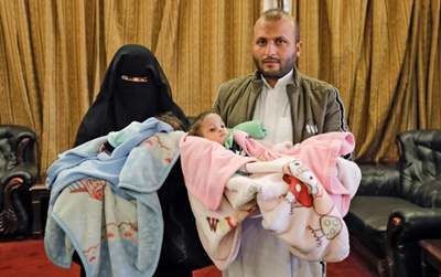 Yemeni separated conjoined twins return home from Jordan: UN agency