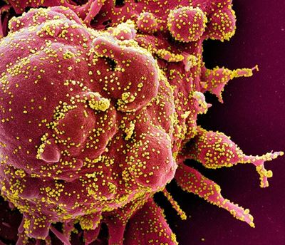 Zinc-hydroxychloroquine found effective in some COVID-19 patients: study