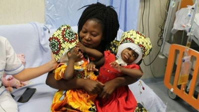 Two conjoined twins separated successfully in Italy 