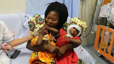 Two conjoined twins separated successfully in Italy 