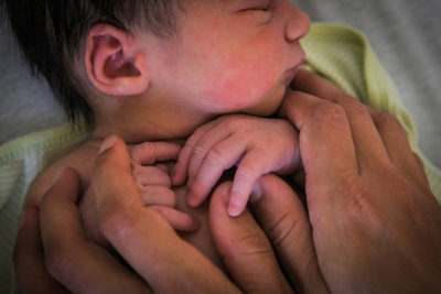 Doctors warn of global C-section 'epidemic'