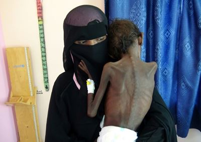 Yemen hospital struggles with number of malnourished children