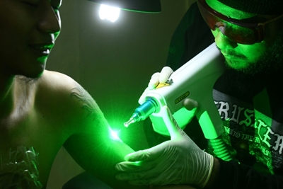 Indonesia's tattoo removers zap the sin from your skin