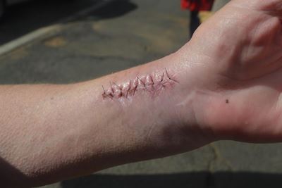 Vrou breek arm na val