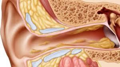 Treating earwax