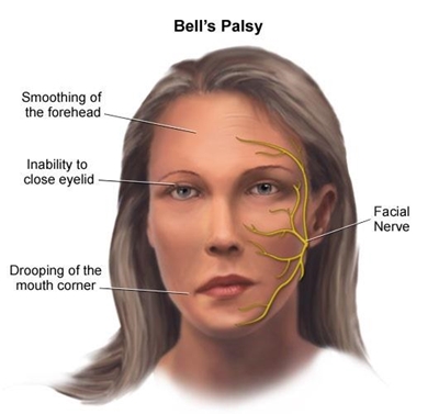 Bell's palsy - causes and treatment