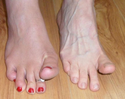 Foot intrinsic muscles