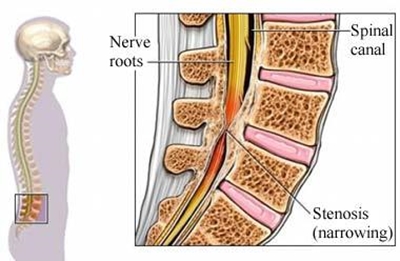 Spinal stenosis