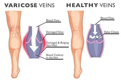 How to prevent varicose veins
