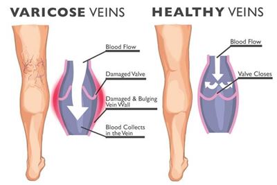 How to prevent varicose veins